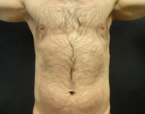 Manhattan liposuction after 16